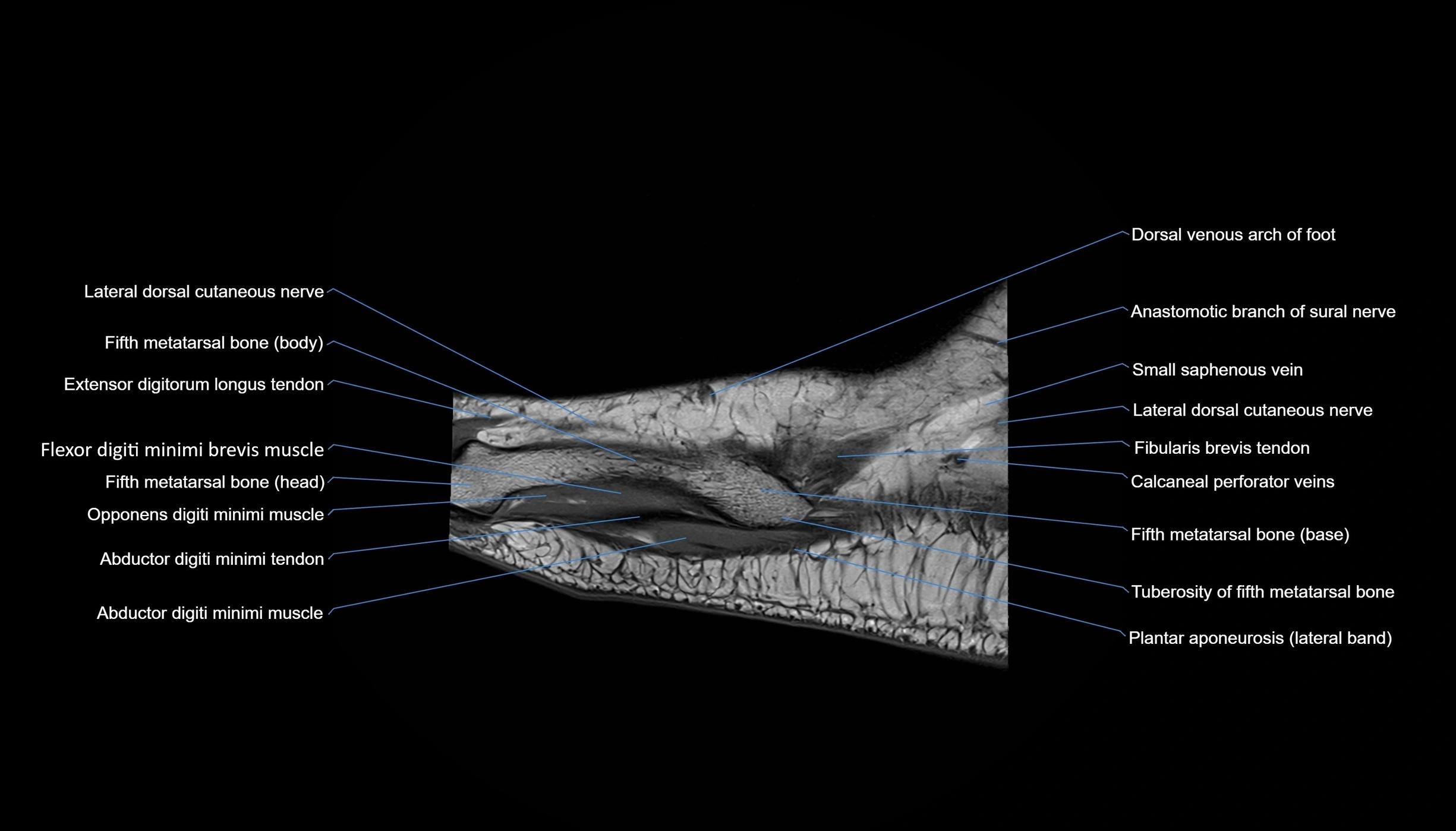 MRI mid foot sagittal cross sectional anatomy 3T  radiology  image-img-00001-00006.webp